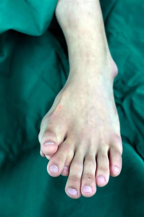 Man With 9 Toes On Foot Has Extras Removed After 21 Yrs