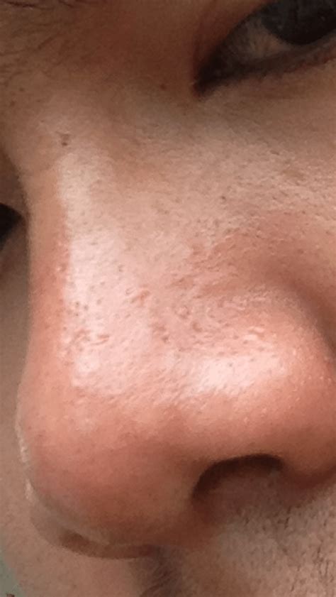 Hypertrophic Scar Nose Acne Causes Treatment And Prevention Martlabpro