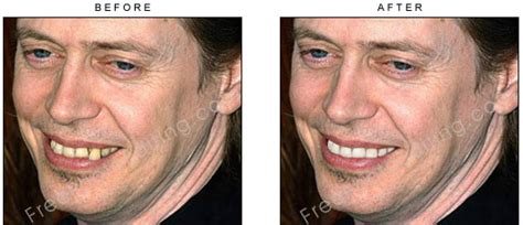 38 Steve Buscemi Teeth Fixed Pics Cante Gallery
