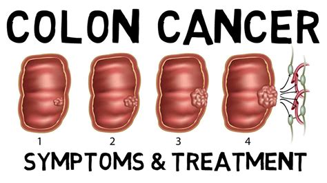 Colon Cancer Symptoms Diagnosis And Treatment Youtube
