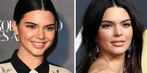 Did Kendall Jenner Get Lip Injections Kendall Jenners Lips At The 2018 Golden Globes