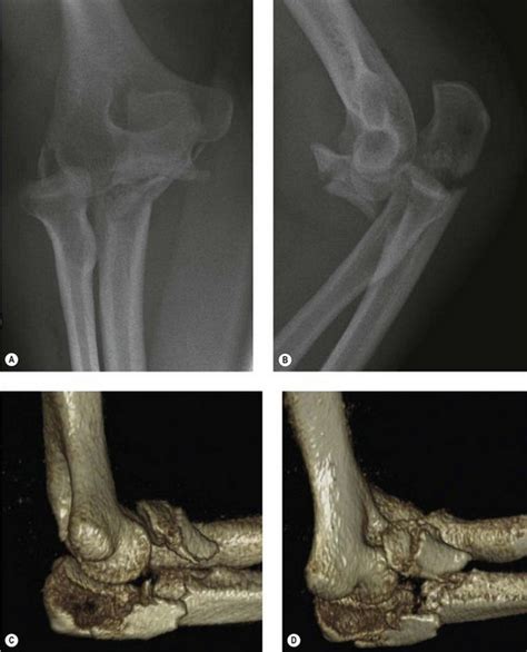 The Treatment Of Adult Monteggia Fracturedislocations