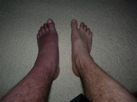 Severe Cellulitis It All Began With A Chipped Toenail Text4meuk