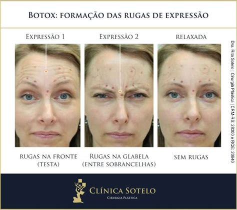 Botox Evita Rugas Futuras Tudo Sobre A Toxina Botulinica Lajeado Rs