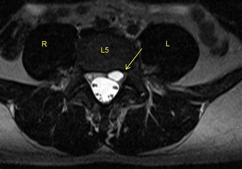 Lumbar Spine Mri Axial