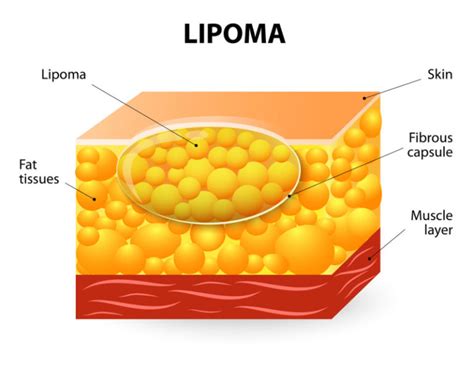 Lipomas Fatty Tumors Nutrimedical