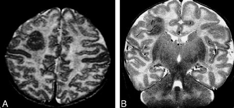 Focal Cortical Dysplasia A And B Axial And Coronal T2 Weighted