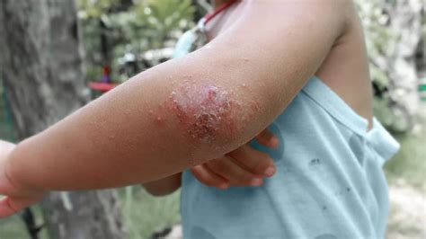 Eczema Scars Causes Treatment And Prevention