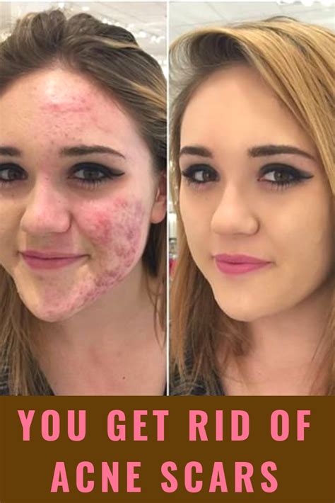 Can You Get Rid Of Bad Acne Scars Shearlingwomenbestquality