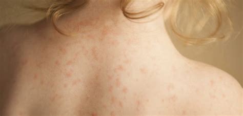 Skin Problems In Babies Rashes Eczema Measles