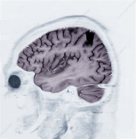 Alzheimers Disease Mri Brain Scan Stock Image C0388632 Science