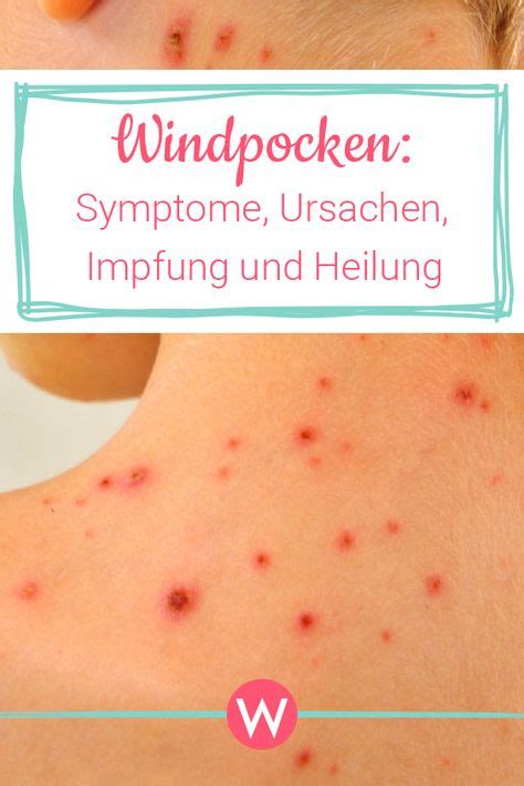 Hier werden die viren nicht via tröpfcheninfektion übertragen, sondern über den inhalt der bläschen. Symptome von Windpocken bei Erwachsenen, Kindern und Babys ...