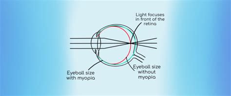 Myopia And Myopia Management Pb Opticians