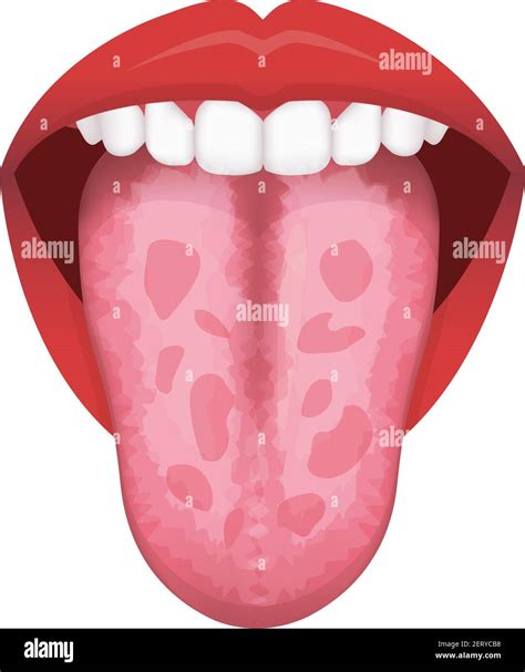 Oral Thrush Candidiasis Tongue Fungus Mouth Infographics Vector