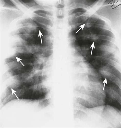 Miscellaneous Chest Diseases Radiology Key