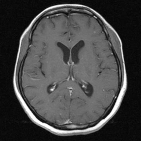 Axial View Of Mri Brain On T1 Post Gadolinium Of Patient 1 Showing