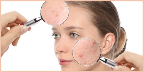 Acne Pigmentation Heres Everything You Need To Know About