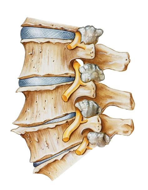 Spinal Stenosis Lumbar Region With Neurogenic Claudication Terisl