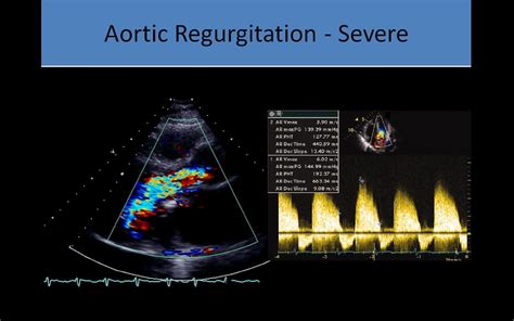 Ultrasound Registry Review - Valvular Abnormalities