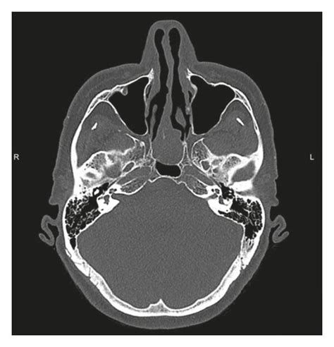 Axial Ct Image Showing A Soft Tissue Mass Centered At The Posterior