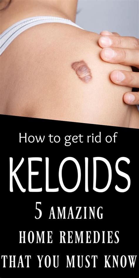 How To Get Rid Of A Keloid 5 Amazing Home Remedies Keloid Skincare Natural Homeremedies