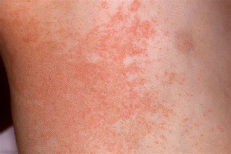 View 27 Allergic Reaction Heat Rash Baby Treatment Begintrendsociety
