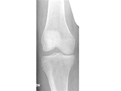 Posterolateral Corner Injury Knee And Sports Orthobullets