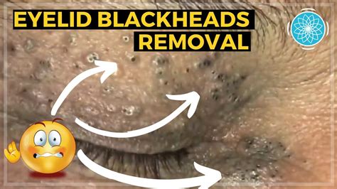 Satisfying Whitehead And Blackhead Removal On The Eyelids Acne Pimple