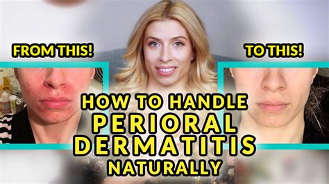 How To Handle Perioral Dermatitis Naturally Youtube