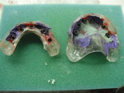 The case of superior vs inferior centers on opposites. J.M Prótese Dentária: protocolo superior e inferior ...