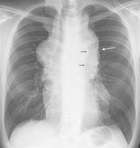 Chest Radiograph Showing Widening Of The Superior Mediastinum Due To