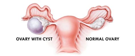 Beza cyst dan fibroid : Cyst / Fibroid (Symptoms and Risk Factors)