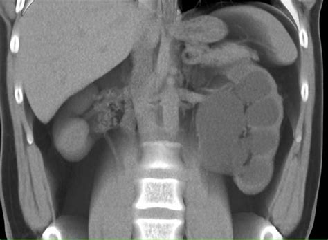 Left Ureteropelvic Junction Upj Obstruction With Hydronephrosis