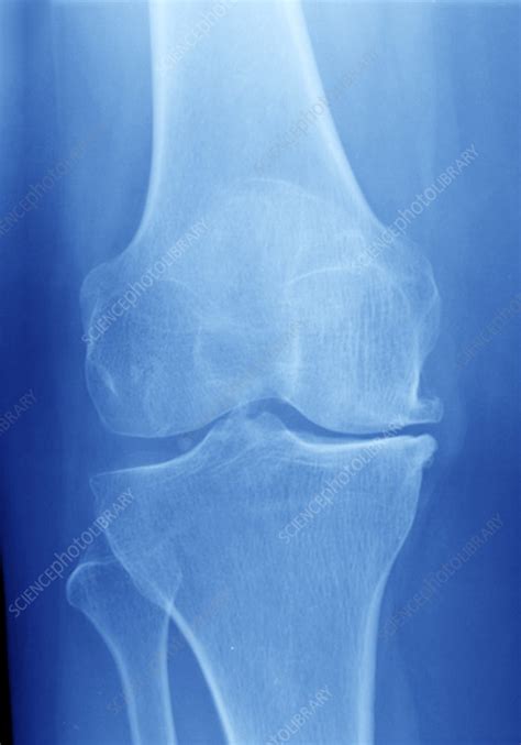 Osteoarthritis Of The Knee X Ray Stock Image C0292439 Science