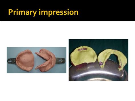 Fabricating the custom tray and bite rim. Complete denture prosthodontics step by step
