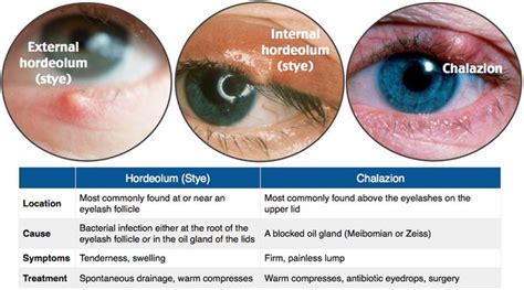 Rosh Review Eye Health Optometry Body Hacks