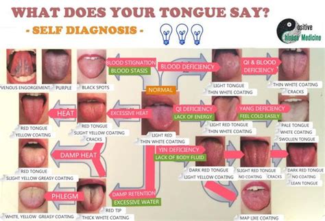 131 Best Burning Tongue Syndrome Images On Pinterest Health Tips