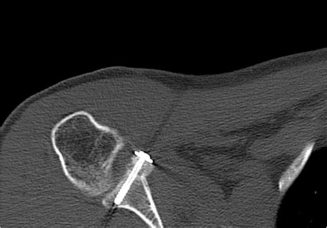 Avulsion Fracture Of The Coracoid Process In A Patient With Chronic
