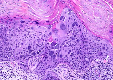 Squamous Cell Carcinoma In Situ Bowens Disease With Massive