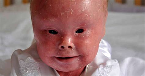 Harlequin Ichthyosis Photos And Stories Of The Rare Skin Disease