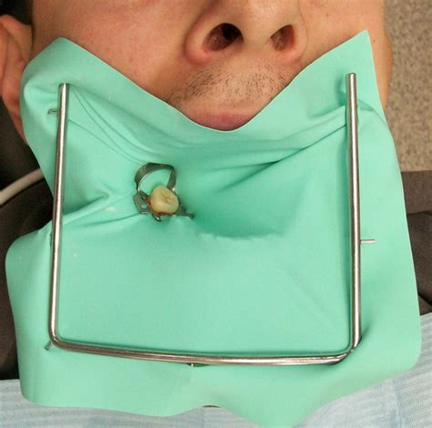 What Is A Rubber Dental Dam News Dentagama