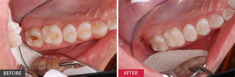 3 can you treat a cavity at home? Case Study: Fill the large and small cavities promptly ...