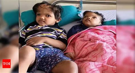 Once Conjoined Twins Ready For Separate Lives Delhi News Times Of