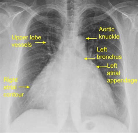 X Ray Quiz Discussion All About Cardiovascular System And Disorders