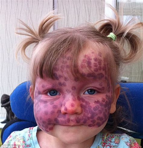 Remarkable Bravery Of Toddler Two Who Has To Have Her Face Lasered