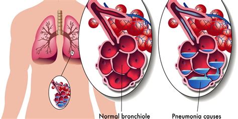 Pneumonie Aiguë Ou Infection Pulmonaire Symptômes Contagion Et