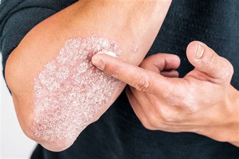 Your Health Psoriasis Is More Than Skin Deep Redland City Bulletin