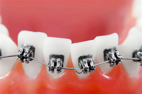How Do Braces Fix Your Teeth Baum Orthodontics