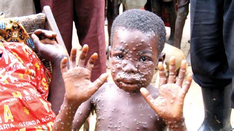 Monkeypox is caused by the monkeypox virus, a member of the same family of viruses as smallpox, although monkeypox can be spread when someone is in close contact with an infected person. WHO traces recent Monkeypox outbreak in UK to Delta State ...