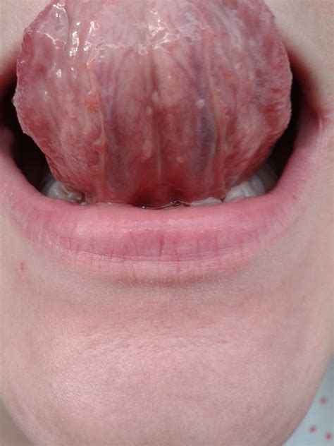 Red Bumps On Side Of Tongue Painful Knee Blue Lump Under Skin On Back Hot Sex Picture